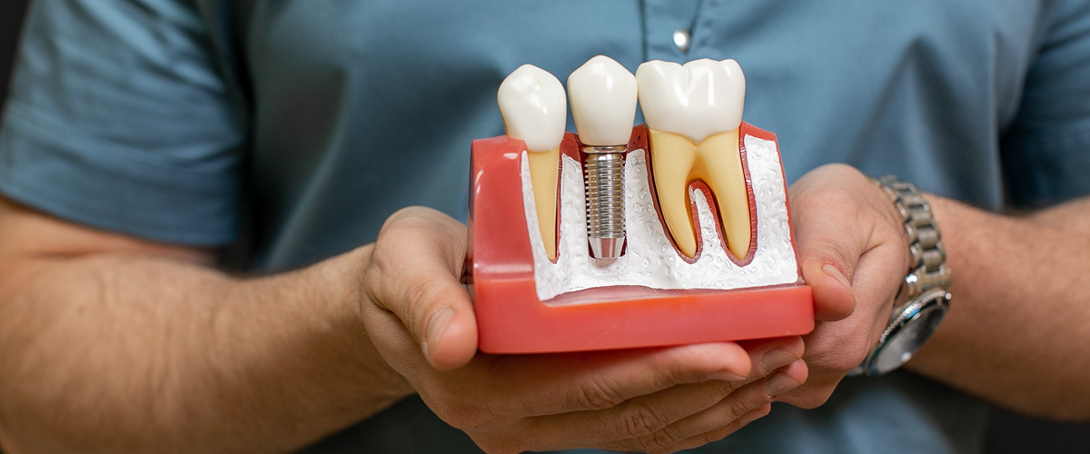 dental-imp